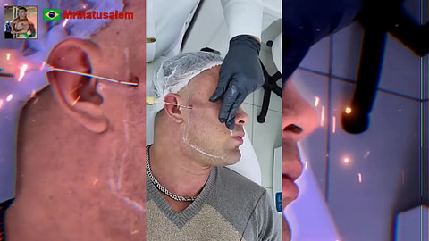 Motivation I transformed myself with facial harmonization see the result